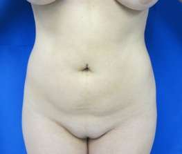 Liposuction Before & After Patient #9287