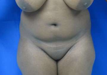 Liposuction Before & After Patient #9290