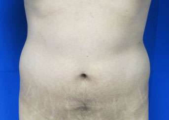Liposuction Before & After Patient #9293