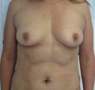 Liposuction Before & After Patient #9299