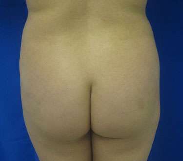 Liposuction Before & After Patient #9302