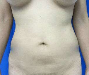 Liposuction Before & After Patient #9305