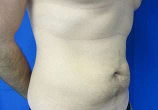 Liposuction Before & After Patient #9310