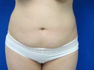 Liposuction Before & After Patient #9313