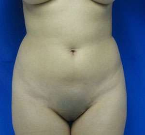 Liposuction Before & After Patient #9316