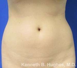 Liposuction Before & After Patient #9323