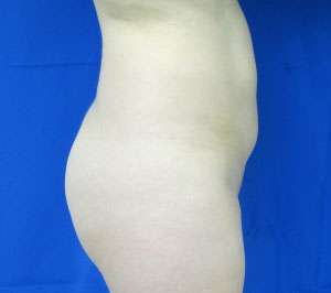 Liposuction Before & After Patient #9332