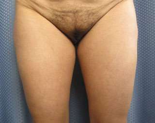 Liposuction Before & After Patient #9335