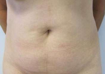 Liposuction Before & After Patient #9338