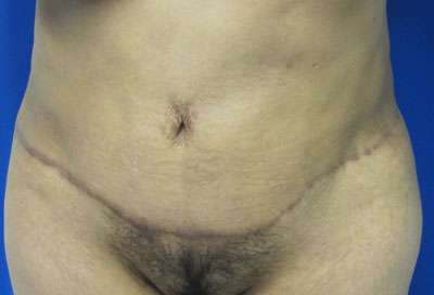 Liposuction Before & After Patient #9341