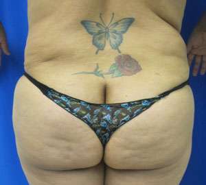 Liposuction Before & After Patient #9344