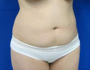 Liposuction Before & After Patient #9347