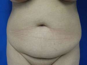 Liposuction Before & After Patient #9353