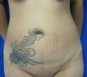 Liposuction Before & After Patient #9356