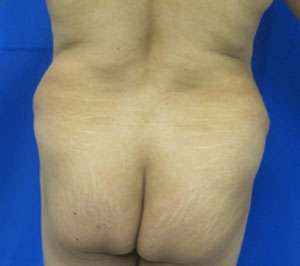 Liposuction Before & After Patient #9359