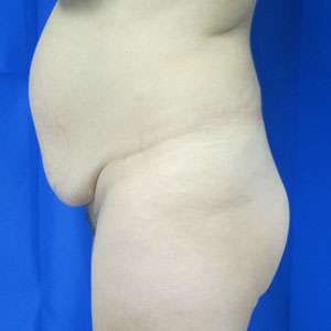 Liposuction Before & After Patient #9362
