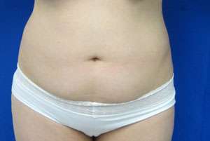 Liposuction Before & After Patient #9365