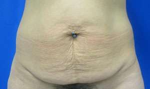 Liposuction Before & After Patient #9368