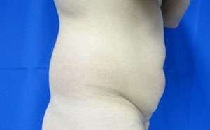 Liposuction Before & After Patient #9371