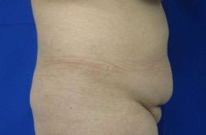 Liposuction Before & After Patient #9374