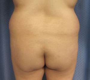 Liposuction Before & After Patient #9377