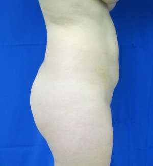 Liposuction Before & After Patient #9380