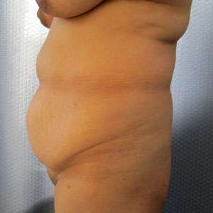 Liposuction Before & After Patient #9386