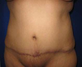 Liposuction Before & After Patient #9389