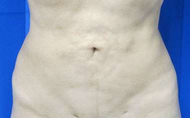 Liposuction Before & After Patient #9395
