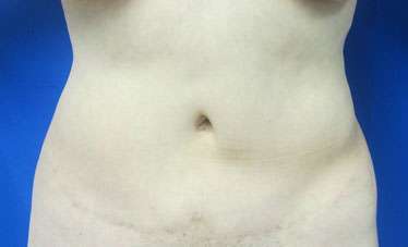 Liposuction Before & After Patient #9401