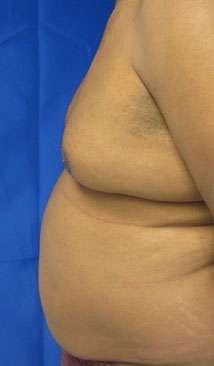 Liposuction Before & After Patient #9404