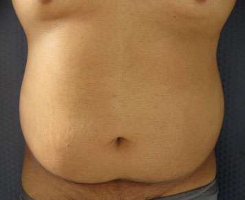 Liposuction Before & After Patient #9407