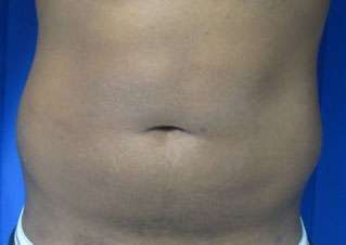 Liposuction Before & After Patient #9414