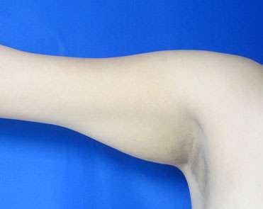 Liposuction Before & After Patient #9417