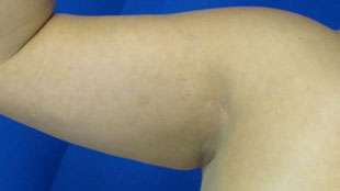 Liposuction Before & After Patient #9422