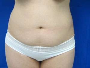 Liposuction Before & After Patient #9425