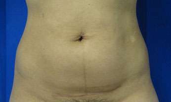 Liposuction Before & After Patient #9428