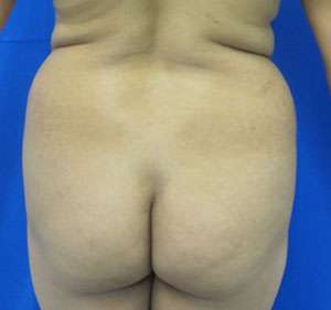 Liposuction Before & After Patient #9434