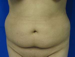 Liposuction Before & After Patient #9442
