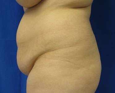 Liposuction Before & After Patient #9445