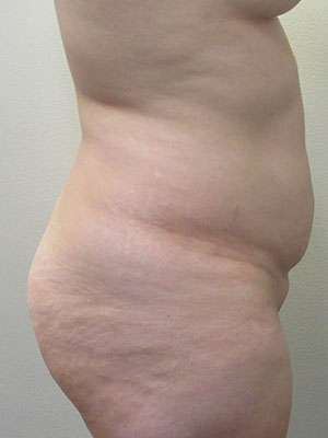 Brazilian Butt Lift Before & After Patient #6248