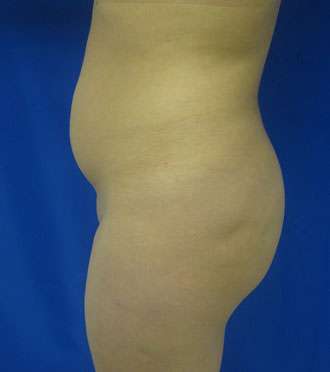Liposuction Before & After Patient #9448