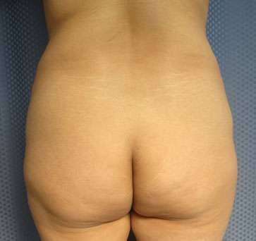 Liposuction Before & After Patient #9451