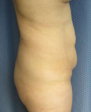 Liposuction Before & After Patient #9454