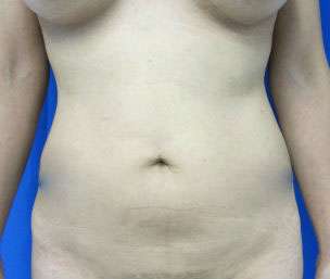 Liposuction Before & After Patient #9457