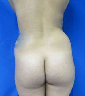 Liposuction Before & After Patient #9467