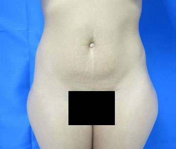 Liposuction Before & After Patient #9472