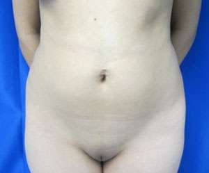 Liposuction Before & After Patient #9475