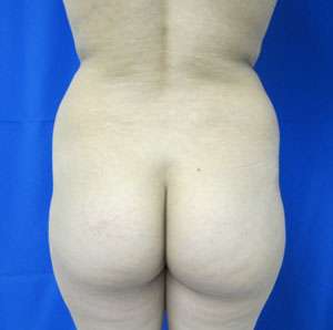 Liposuction Before & After Patient #9478