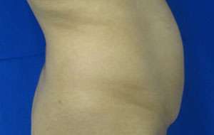 Liposuction Before & After Patient #9481